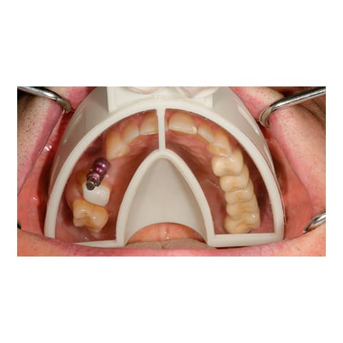 Cubeta de Plástico Miratray Implant Superior Pequeña S1
