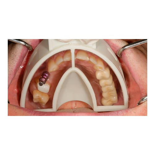 Cubeta de Plástico Miratray Implant Inferior Pequeña I1