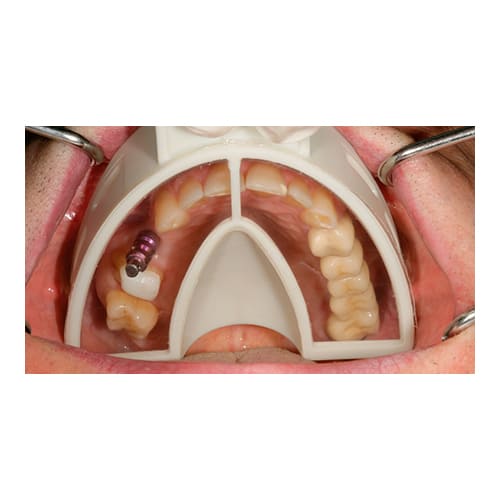 Cubeta de Plástico Miratray Implant Superior Grande S3